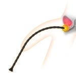 Silicone Urethral Catheterization Stick - Image 2