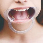 Cheek Retractor Dental Mouth Gag - Image 6