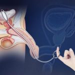 Oval Bullet Urethral Sound - Image 7